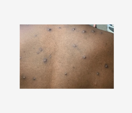 an image of a mpox rash
